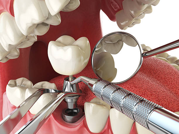 Best Emergency Treatment for Oral Infections in Santa Clarita, CA